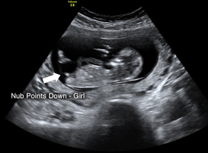 Downward pointing nub girl gende scan