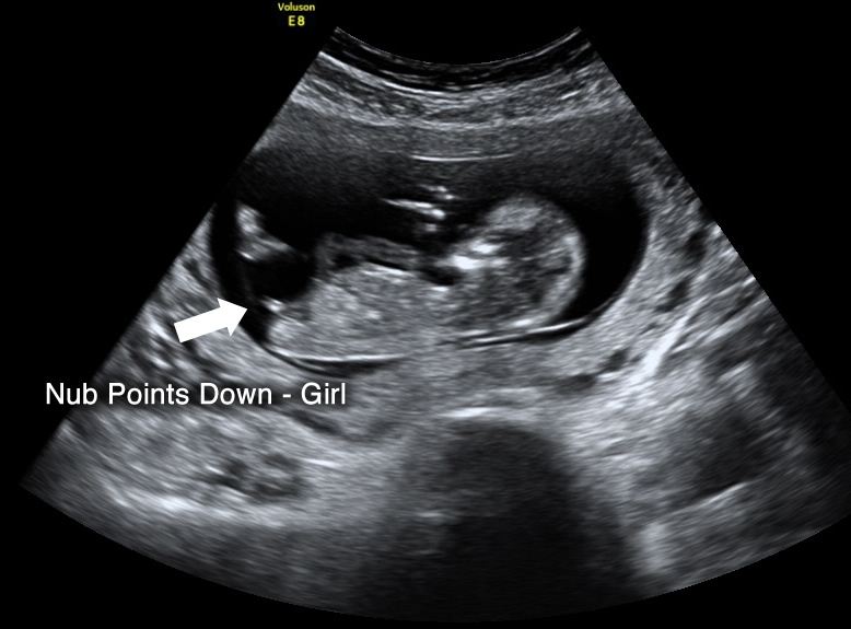 Detect gender when can ultrasound can ultrasound