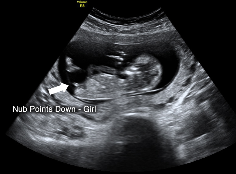 pregnant boy ultrasound