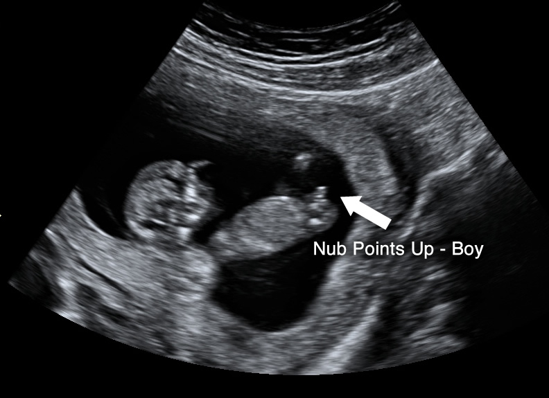 Can ultrasound detect gender when Fetal ultrasound