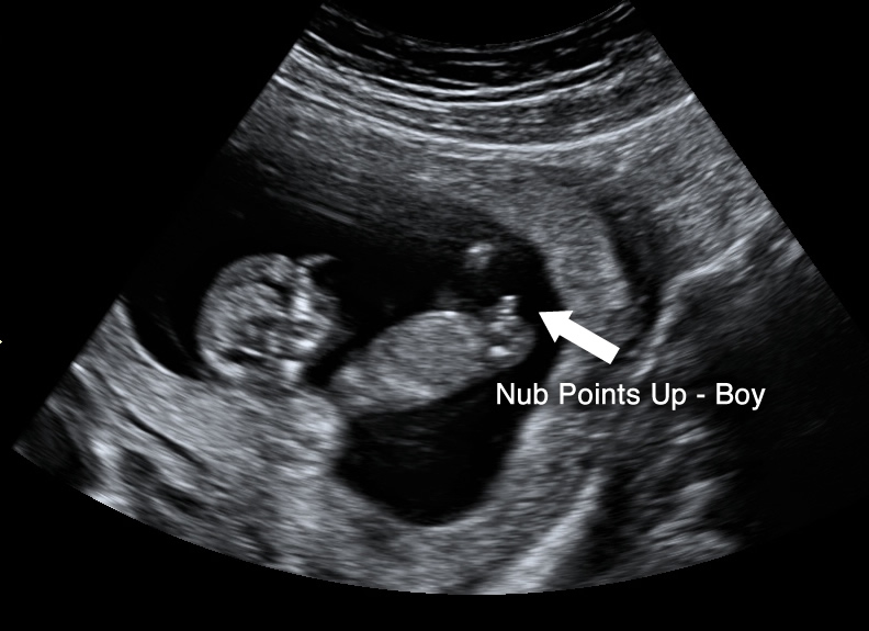 fetal gender assignment by first trimester ultrasound