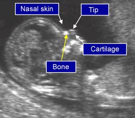 nuchal scan kent