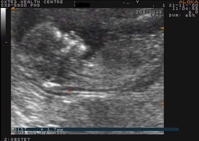 Nuchal Scan Diagnostic Ultrasound