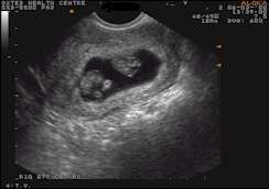 Fetal viability scan