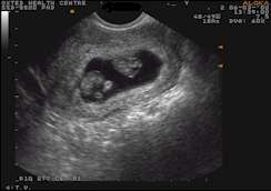 Pregnancy Scan/Viability Scan Diagnostic Ultrasound Services