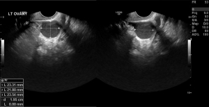 endometrioma