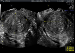 fibroid