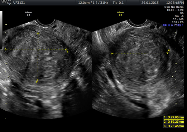 Uterus Fibroids Ultrasound