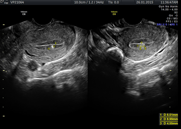 What Are Menstrual Migraines and How Can They Be Managed? - The Ultrasound  SuiteThe Ultrasound Suite