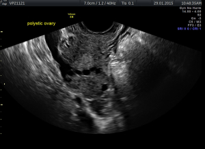 polycystic ovaries scan