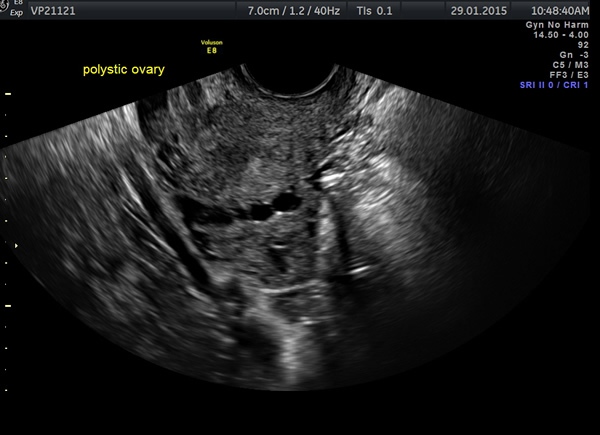 polycystic ovaries scan