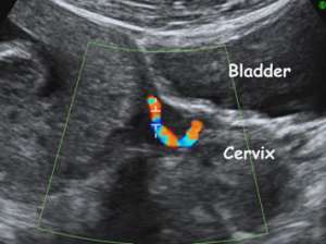 Color Doppler uterine arteries