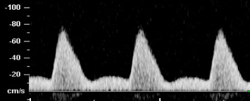 Uterine arteries wave form